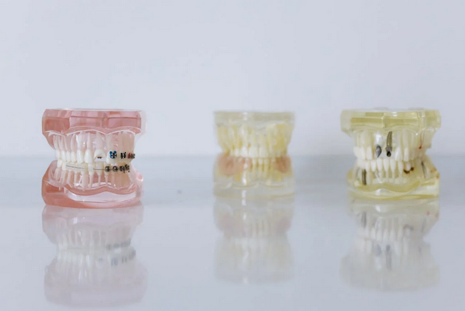 Top Reasons Your Dentist Recommends Dental Implants
